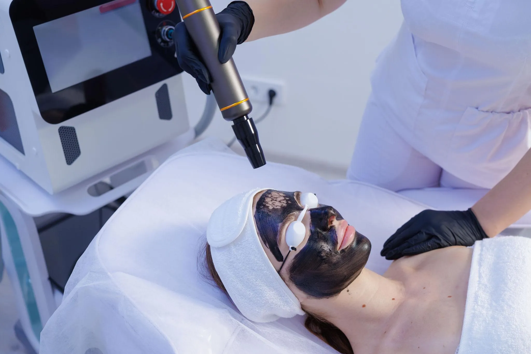Carbon Laser treatment